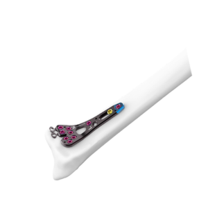 AUXEIN 2.4MM AV-WISELOCK DISTAL RADIUS VOLAR RIM  M PLATE  