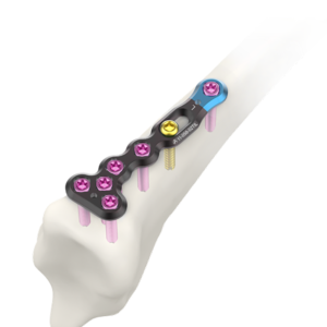 AUXEIN 2.4MM AV-WISELOCK T-DISTAL RADIUS SMALL  FRAGMENT M PLATE  