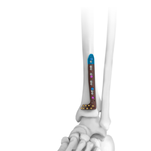 AUXEIN 2.7-3.5MM VARIXIS ANTEROLATERAL DISTAL  TIBIA PLATE  