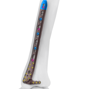 AUXEIN 2.7-3.5MM VARIXIS ANTEROMEDIAL DISTAL  TIBIA PLATE  