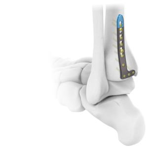 AUXEIN 2.7MM VARIXIS DISTAL TIBIA L-PLATE  