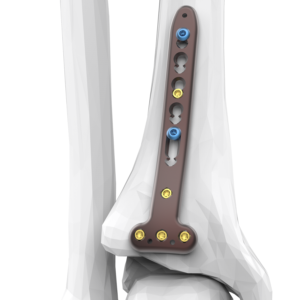 AUXEIN 2.7MM VARIXIS DISTAL TIBIA T-PLATE  