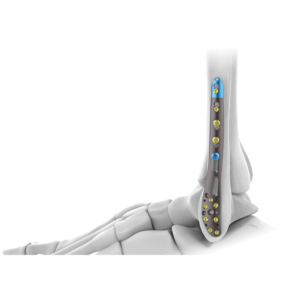 AUXEIN 2.7MM VARIXIS LATERAL DISTAL FIBULA  PLATE  