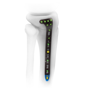 AUXEIN 3.5MM VARIXIS PROXIMAL TIBIA PLATE, SMALL  BEND-  