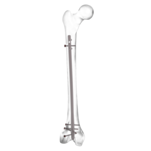 AUXEIN RETROGRADE FEMUR NAIL WITH BONE  