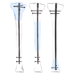 AUXEIN SUPRAPATELLAR TIBIA NAIL  